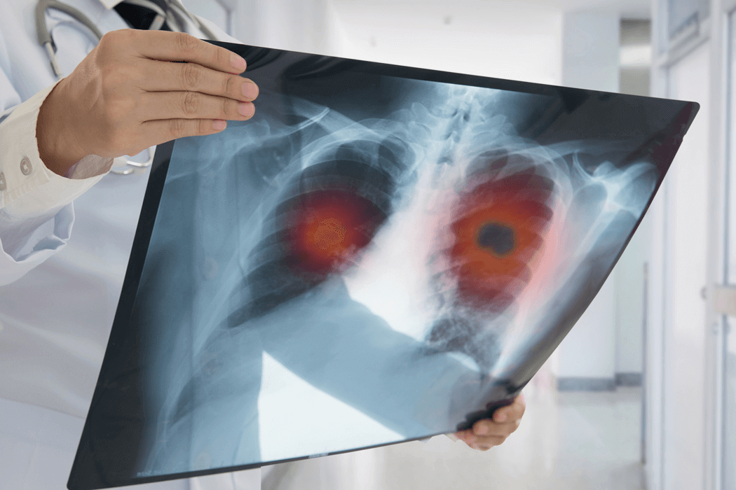 X-ray image depicting lung cancer